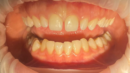 Закрытие промежутков между фронтальными каналами верхней челюсти