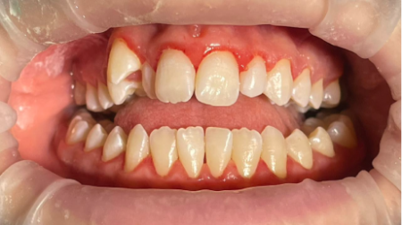 Профессиональная гигиена полости рта