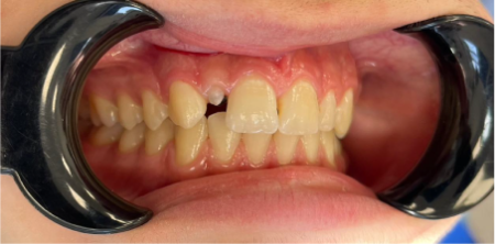 Наращивание зуба 1.2