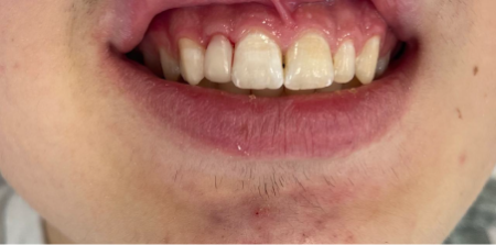 Наращивание зуба 1.2