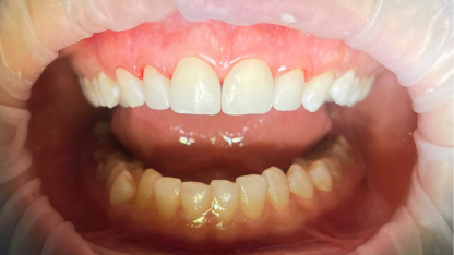 Закрытие промежутков между фронтальными каналами верхней челюсти