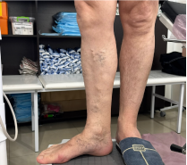 Склеротерапия