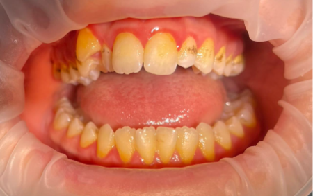 Профессиональная гигиена полости рта