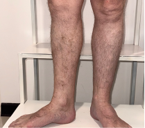 Склеротерапия